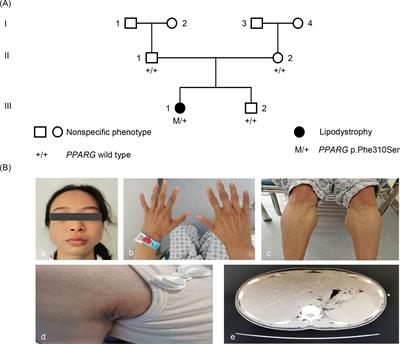 Case Report: A New Peroxisome Proliferator-Activated Receptor Gamma Mutation Causes Familial Partial Lipodystrophy Type 3 in a Chinese Patient